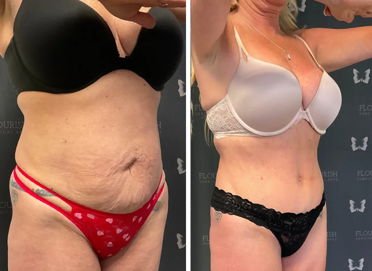 Before and After Gallery: Liposuction C Banner