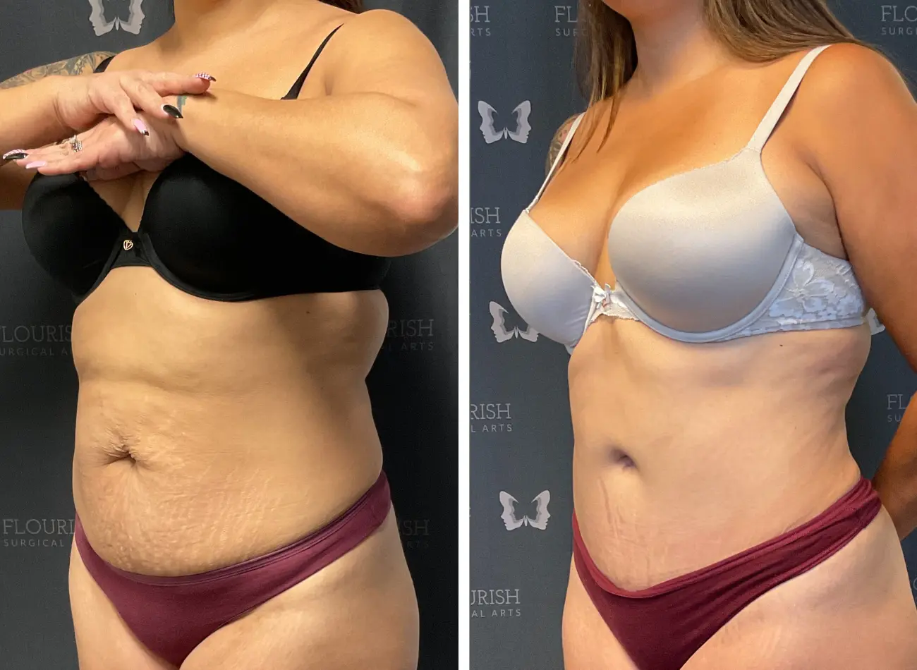 Before and After Gallery: Liposuction D Banner
