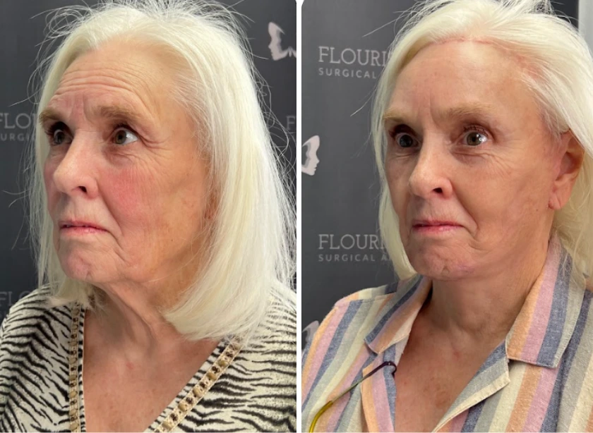Before and After Gallery: Face Lift