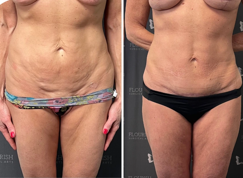 Before and After Gallery: Liposuction A Banner