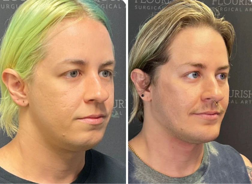 Jaw Implants (2)
