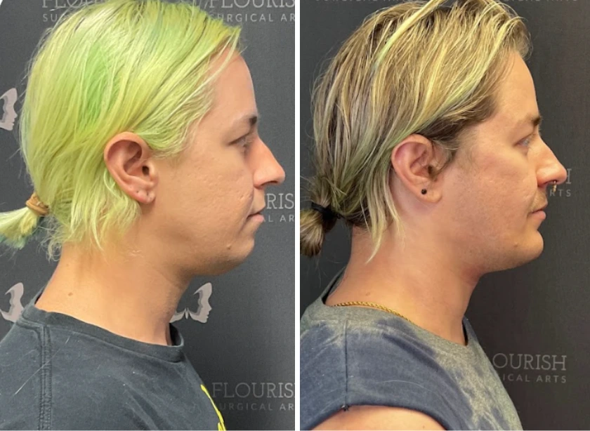 Jaw Implants (4)