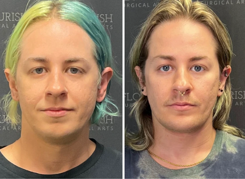 Jaw Implants