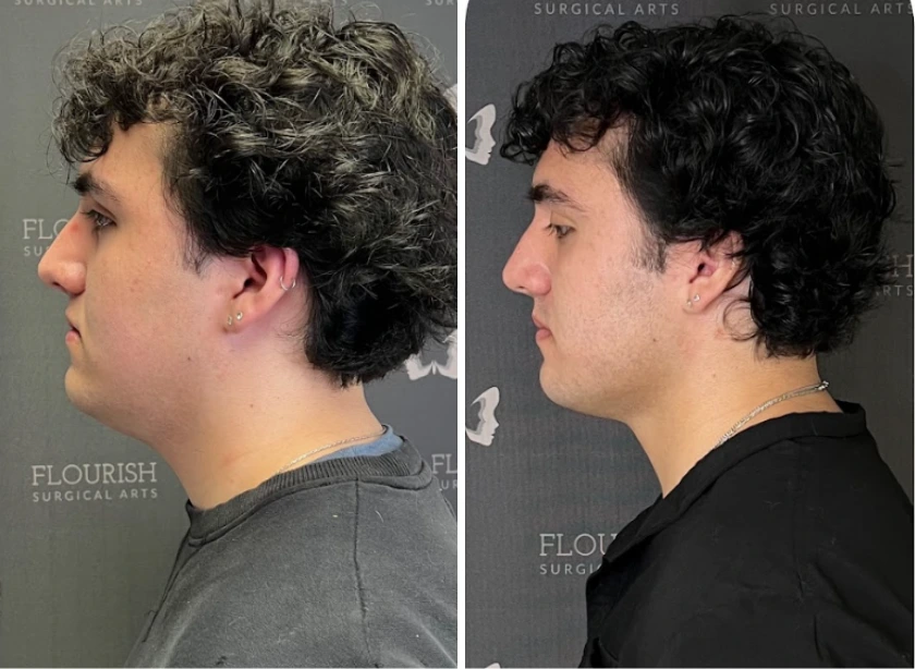 Neck Lipo (2)