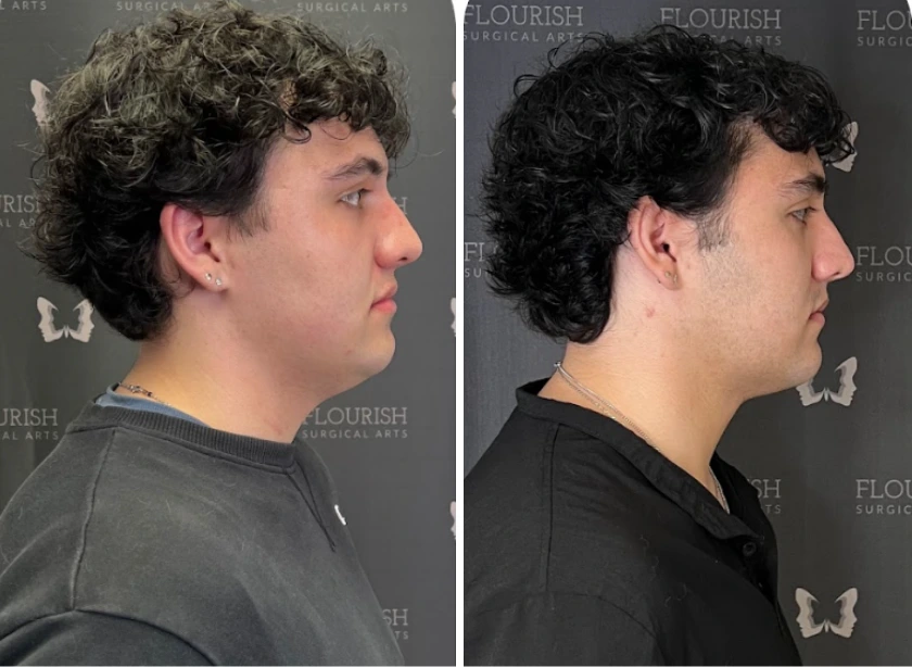 Neck Lipo (3)