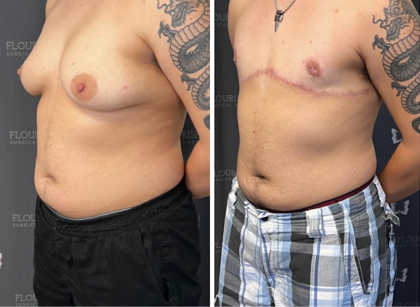 Top Sx With Free Nipple Graft - Case 1 (3)