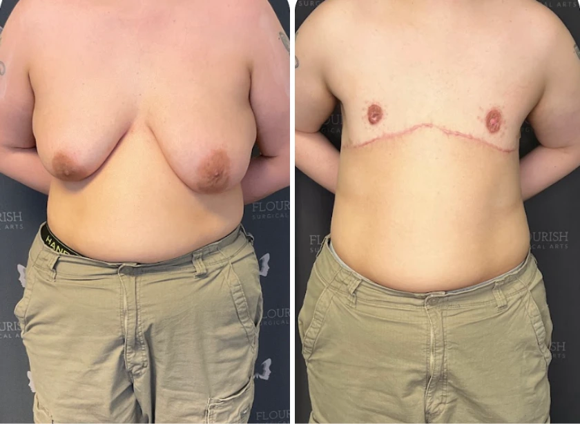 Top Sx With Free Nipple Graft - Case 2 (2)