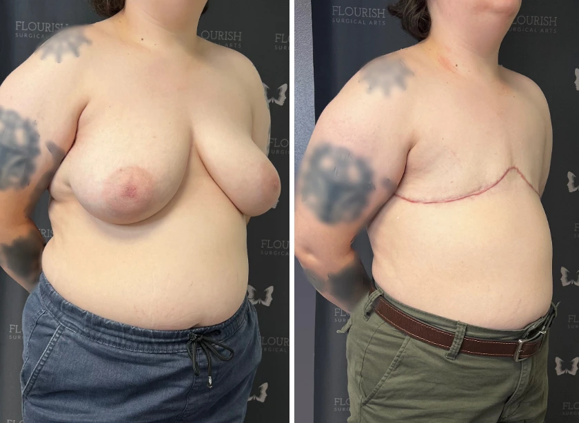Top Sx Without Free Nipple Graft