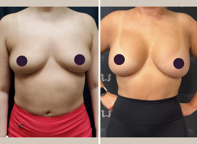 Before & After Gallery: Breast Implant Banner
