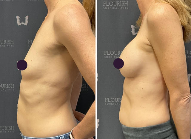 Before & After Gallery: Breast Implant Banner
