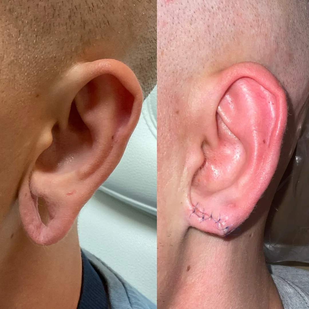 Before and after ear surgery, left side shows stretched earlobe, right side shows restored ear with sutures