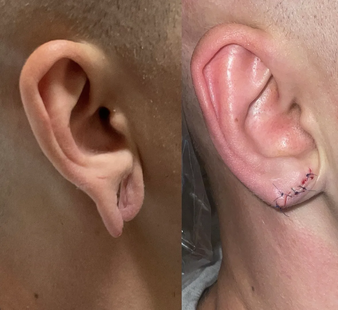 Before and after ear surgery, left side shows elongated earlobe, right side shows reconstructed ear with surgical closure
