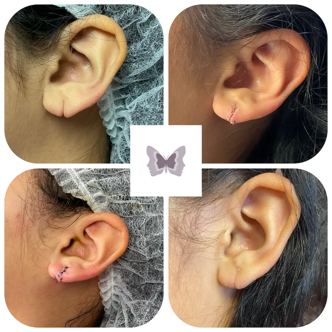 Four before and after earlobe repair cases showing torn earlobes restored with surgical repair and minimal scarring