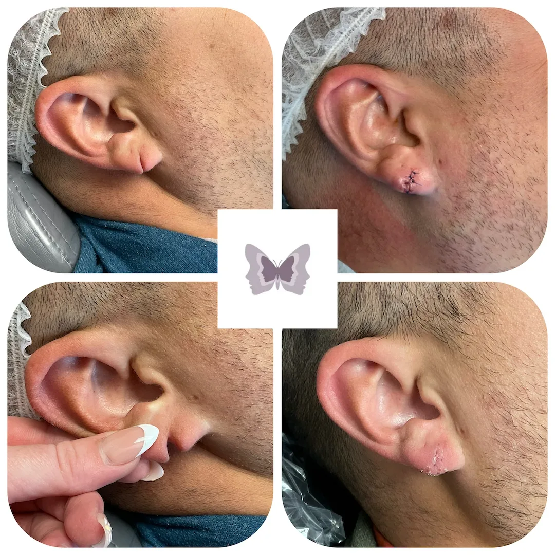 Four before and after earlobe repair cases showing stretched earlobes and surgical correction with visible sutures healing