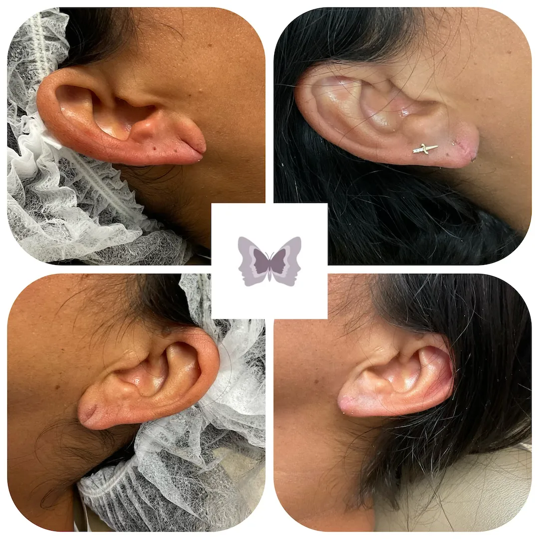 Four before and after earlobe repair cases showing elongated earlobes repaired with improved contour and definition