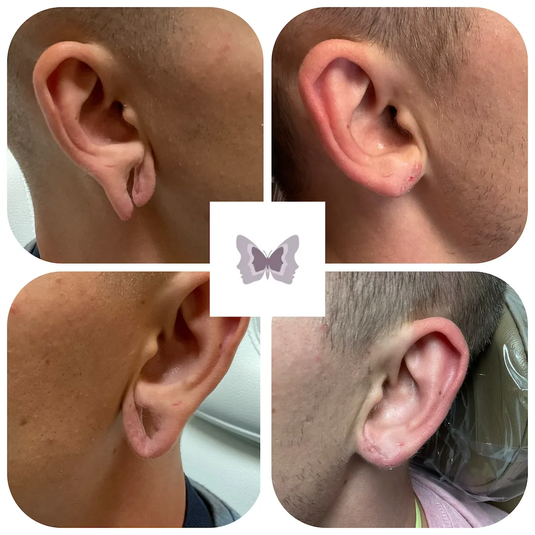 Four before and after earlobe repair cases showing various degrees of torn and stretched earlobes restored to normal appearance