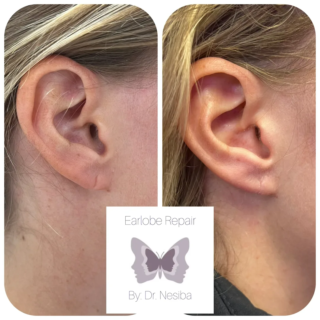 Before and after earlobe repair by Dr. Nesiba showing torn earlobe on left and healed earlobe on right