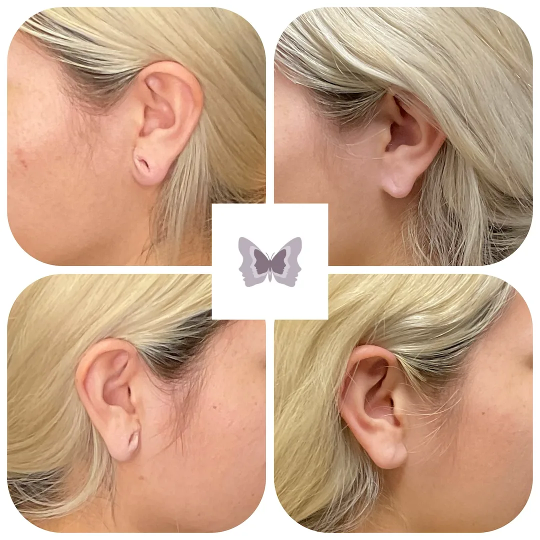 Four views of patient's ear and jawline showing before and after results