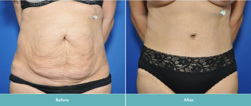 Abdominoplasty (Tummy Tuck) (1)