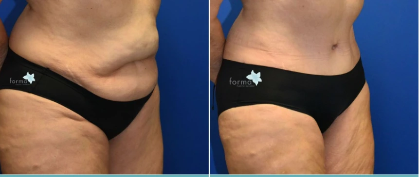 Abdominoplasty (Tummy Tuck) (2)