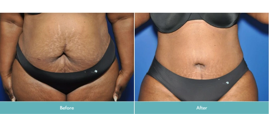 Abdominoplasty (Tummy Tuck) (3)