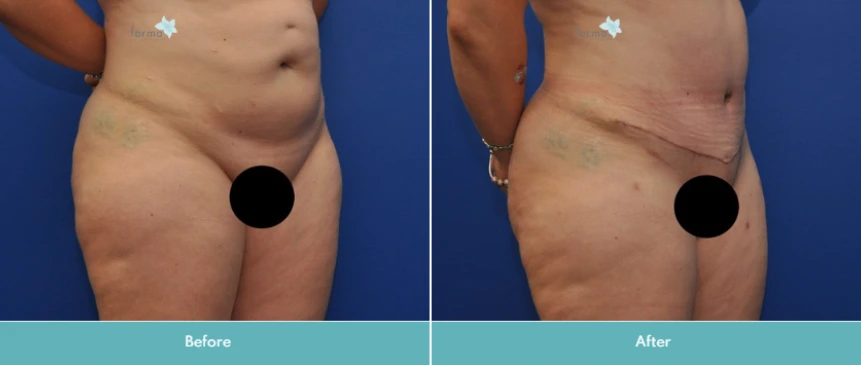 Abdominoplasty (Tummy Tuck)