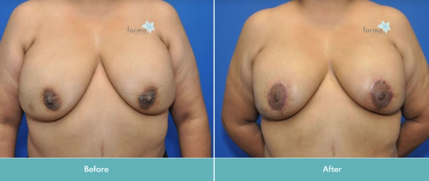 Breast Implant Exchange (1)