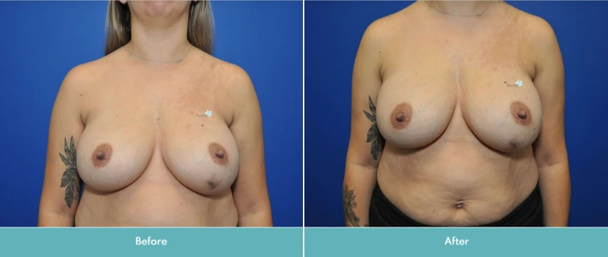Breast Implant Exchange (10)