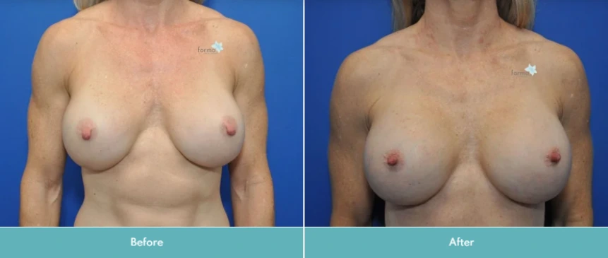 Breast Implant Exchange (2)