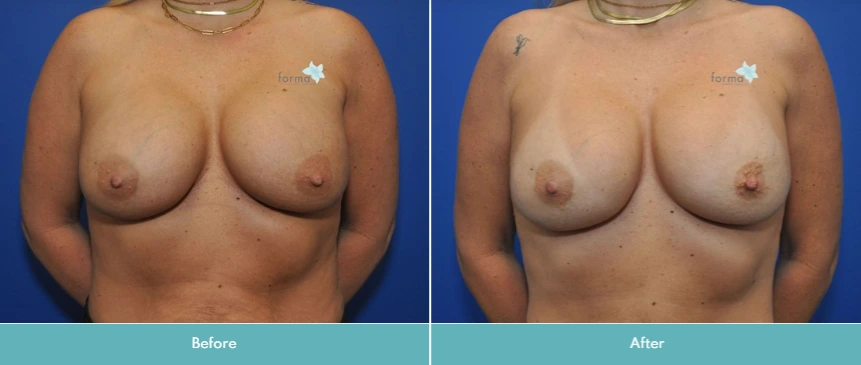 Breast Implant Exchange (3)