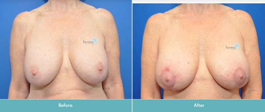 Breast Implant Exchange (4)