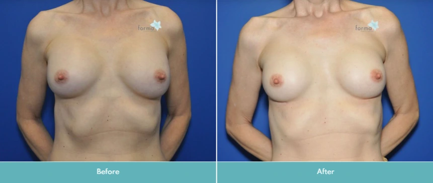 Breast Implant Exchange (5)