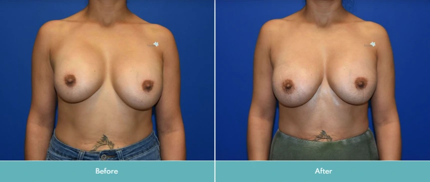 Breast Implant Exchange (6)