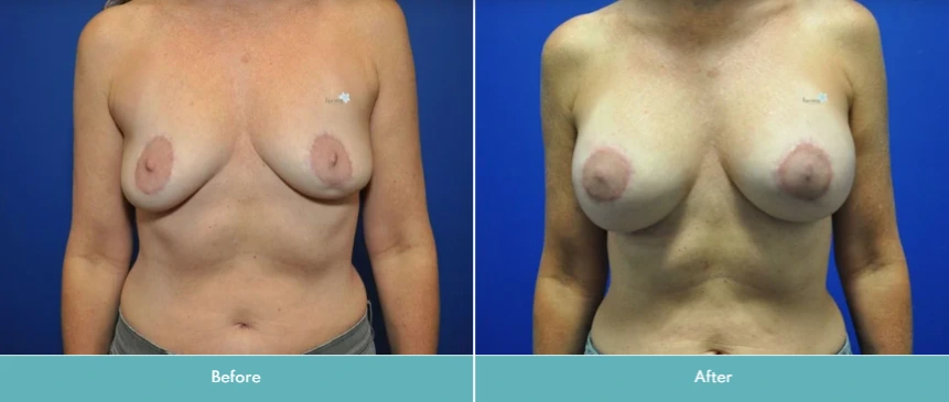 Breast Implant Exchange (8)