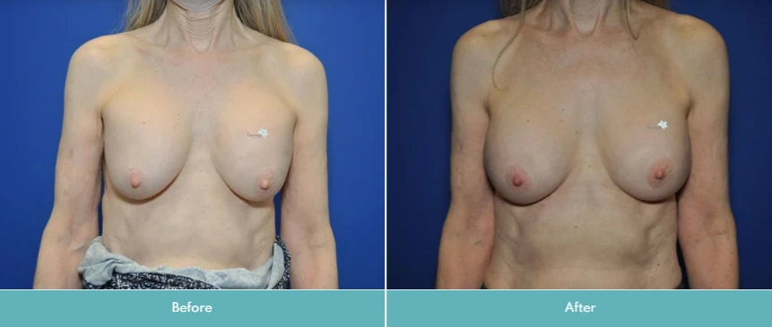 Breast Implant Exchange (9)