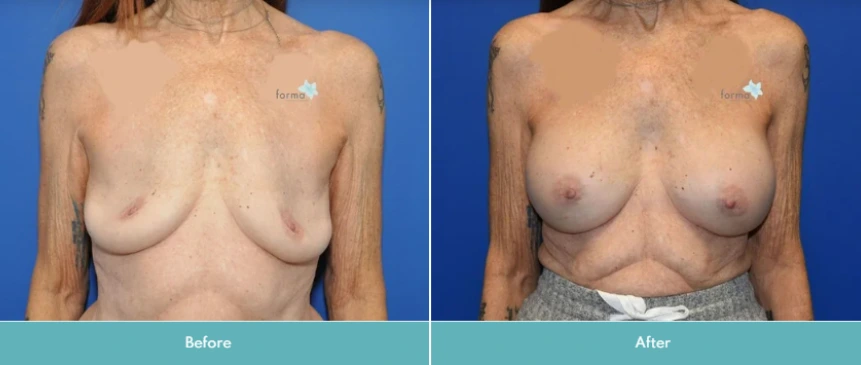 Breast Implant Exchange