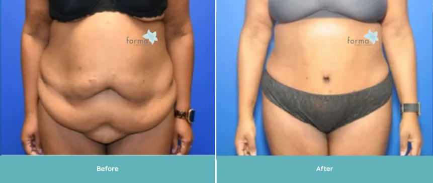 Before and after tummy tuck results showing front torso view with reduced abdominal fullness and improved contour