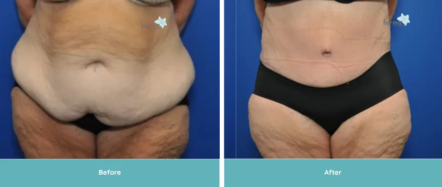 Before and after liposuction results showing front lower torso with reduced fullness and improved definition