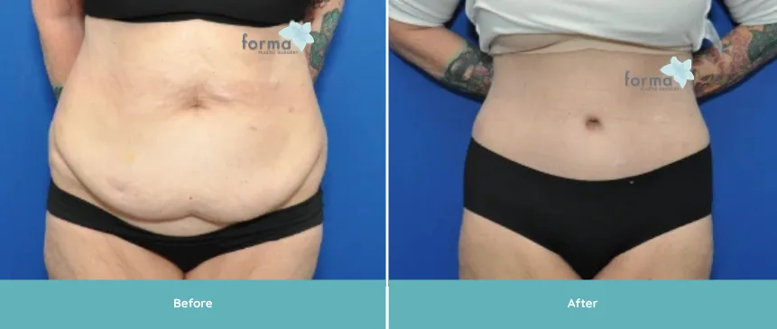 Woman's abdomen before and after tummy tuck surgery