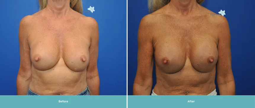 Before and after breast implant results showing front view comparison on blue background