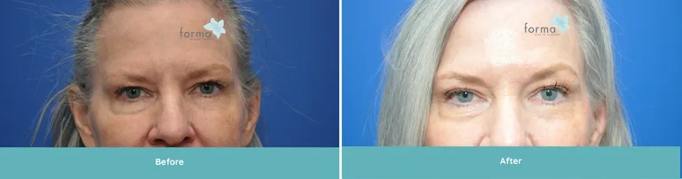 Before and after facial procedure showing improved skin texture and appearance