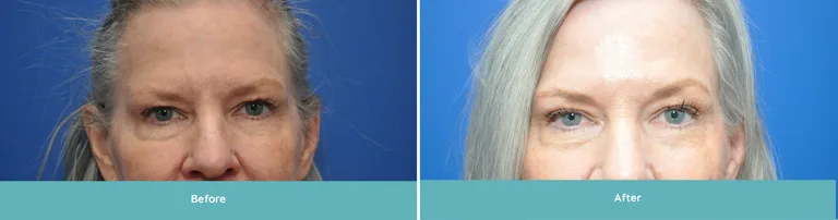 Before and after upper blepharoplasty comparison showing woman's face
