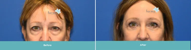 Woman's face before and after facial rejuvenation procedure