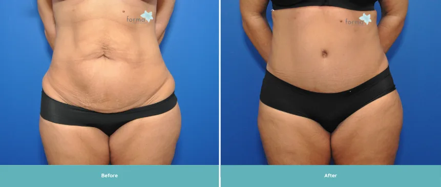 Woman's abdomen before and after abdominoplasty surgery