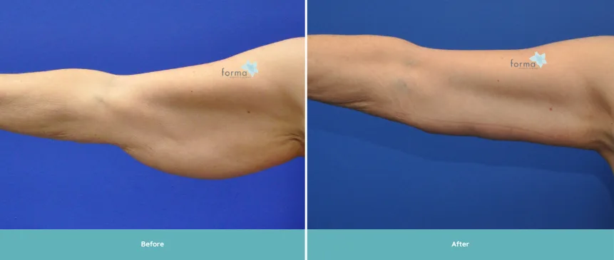 Before and after brachioplasty showing arm with skin tightening and enhanced definition