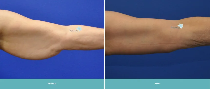 Before and after brachioplasty showing reduced arm skin laxity and improved contour