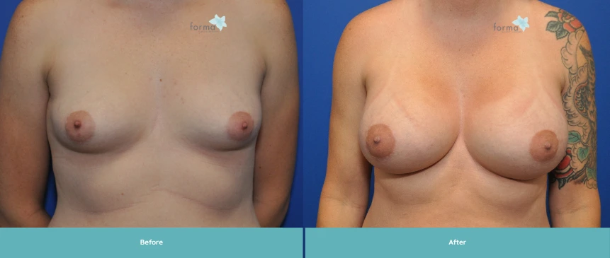 Woman's torso before and after breast augmentation surgery