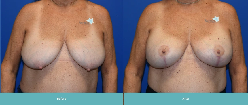Breast augmentation and mastopexy before and after frontal comparison by Dr. Yao