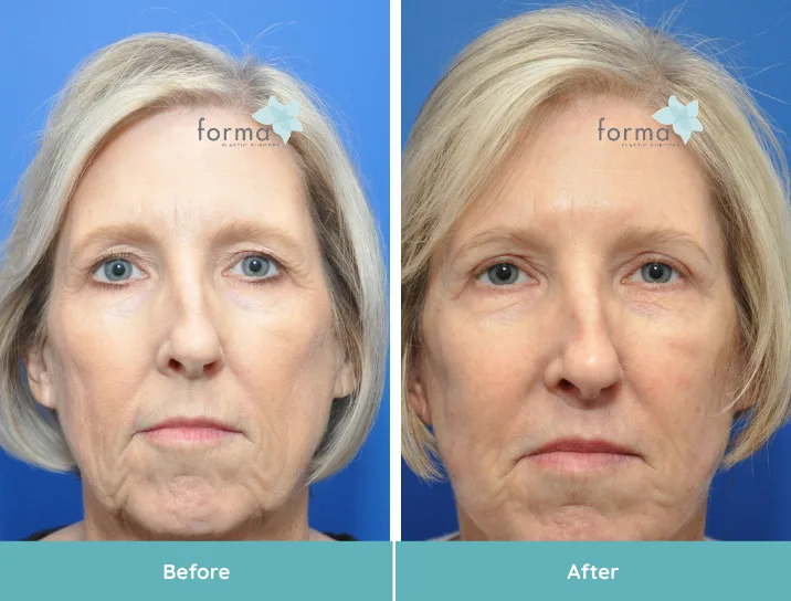 Facelift before and after comparison showing frontal face view with improved skin texture and lift