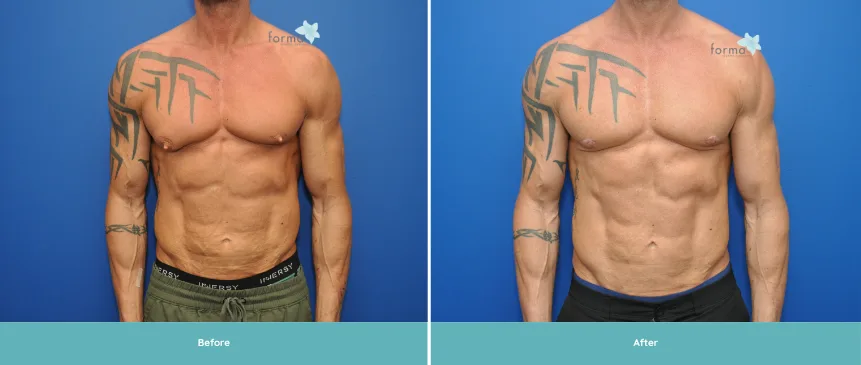 Before and after gynecomastia surgery showing reduced breast tissue and improved chest contour